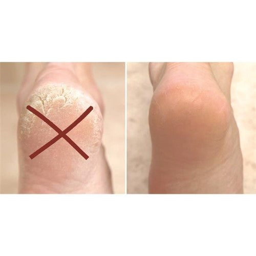 ##product## - PEDIBLISS X1 - Soin des pieds - Suisseteleachat