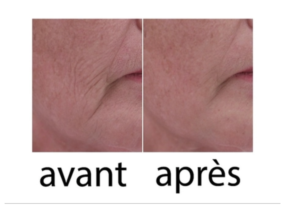 Wrinkle power X2